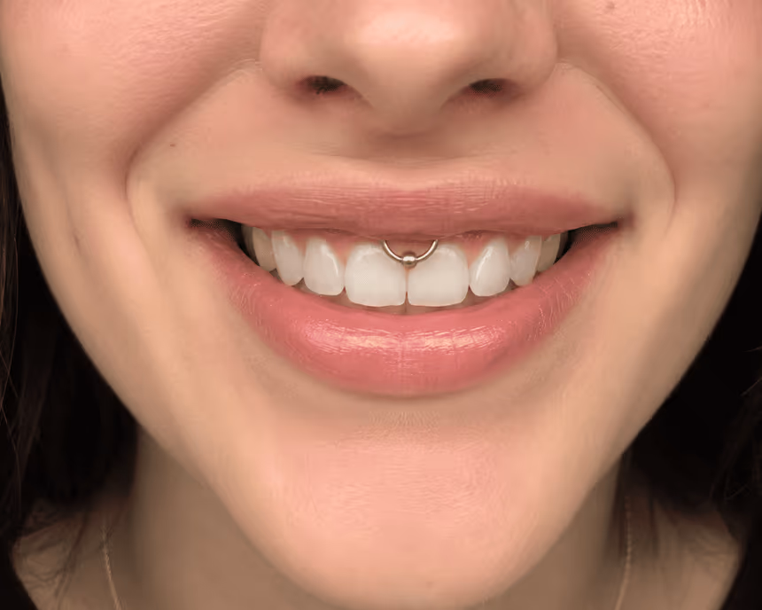 Schéma d'un piercing smiley sur le frein de la lèvre supérieure